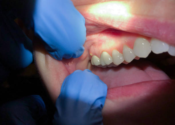 Best Emergency Treatment for Dental Infections or Abscesses in Bigfoot, TX