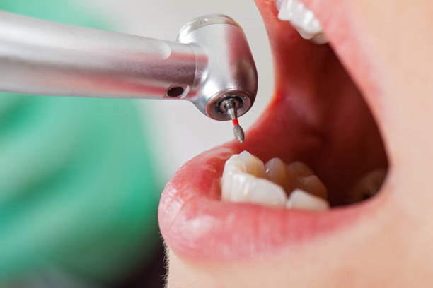 Best Emergency Treatment for Dental Infections or Abscesses in Bigfoot, TX